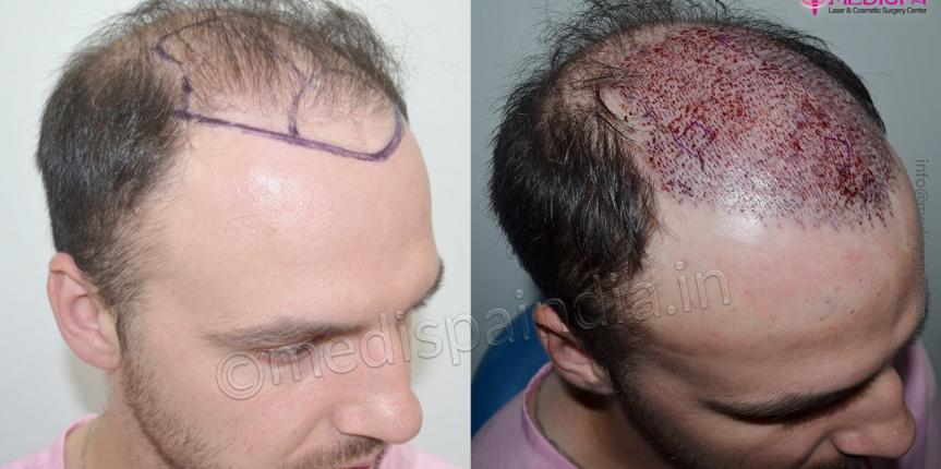 ireland hair transplant results