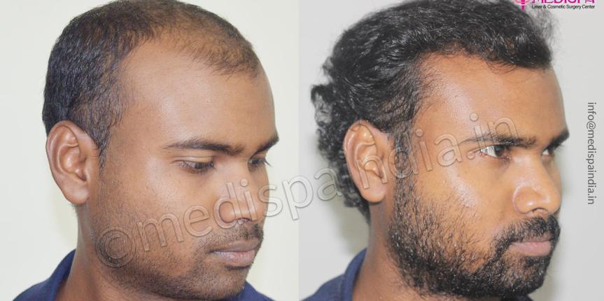 hair transplant clinics in bengaluru