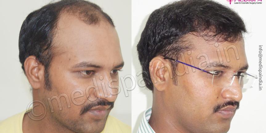 hair transplant cost bangalore