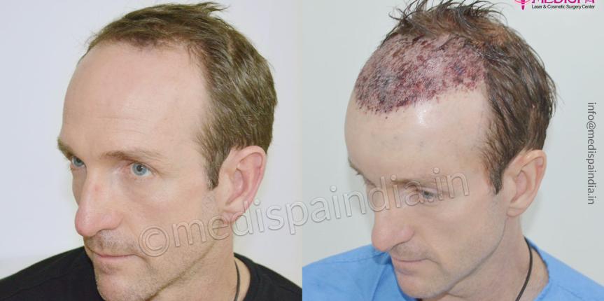 hair transplant results australia