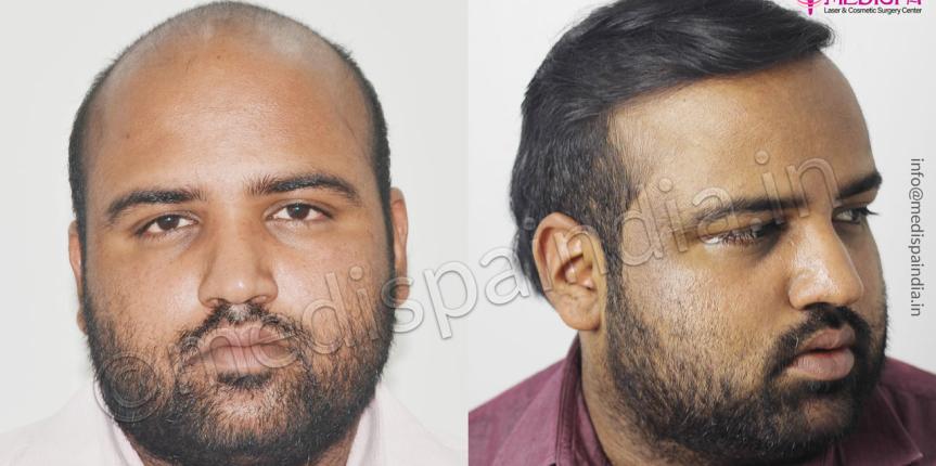 best hair transplant doctors in gurgaon