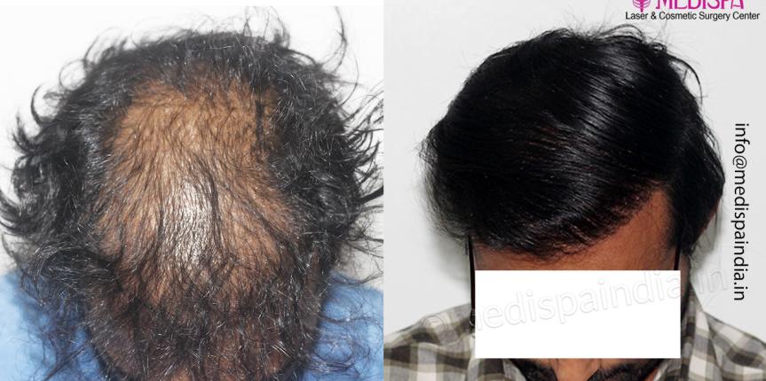 bad hair transplant repair india