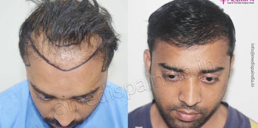 revision hair transplant pune