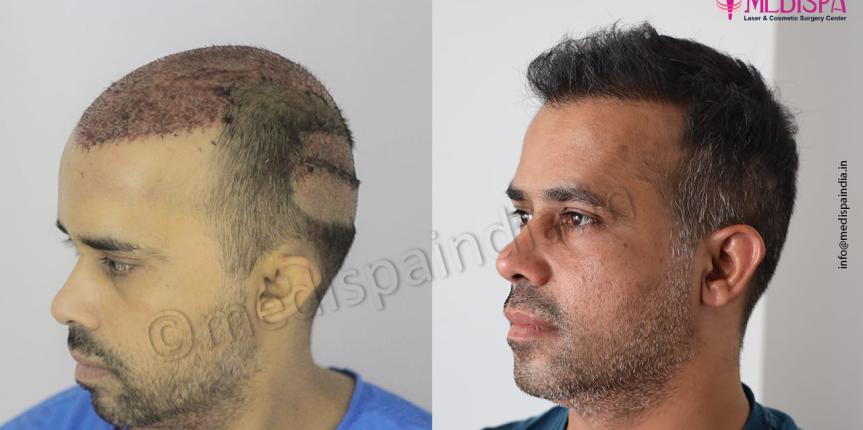 hair restoration results in india