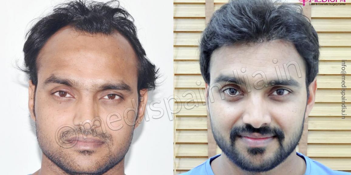 Best Hair Transplant Delhi