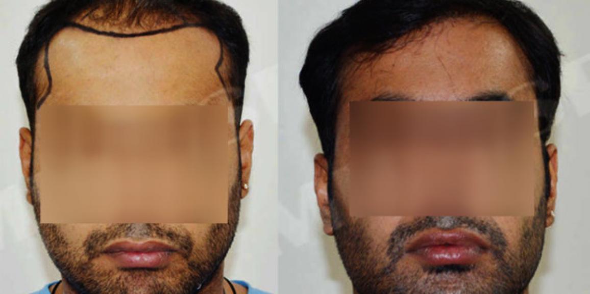 Get a Fuller Head of Hair: Hair Transplant Options in India