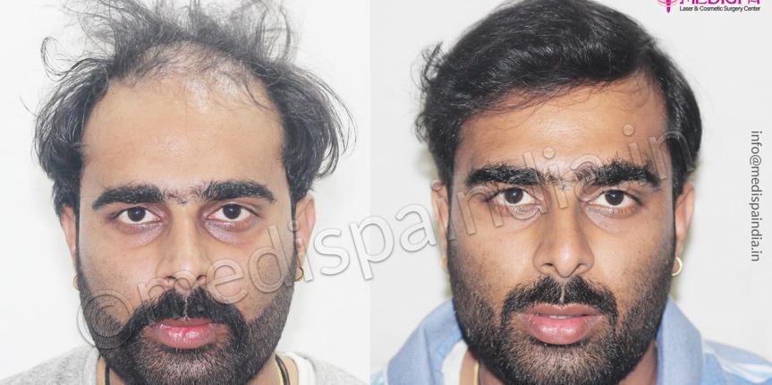 fue hair transplant jaipur