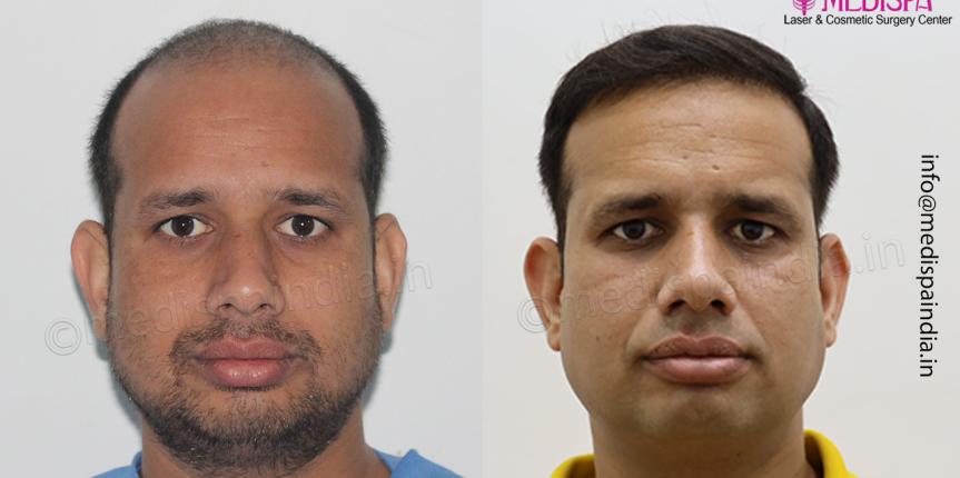 hair transplant india