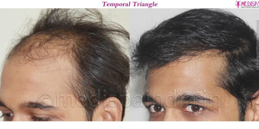 hair transplant newzealand