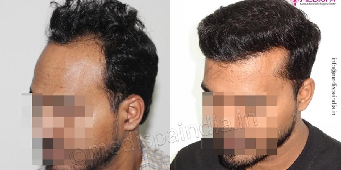 How To Take Care of Your Scalp After Hair Transplant Procedure?