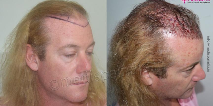 hair restoration australian results