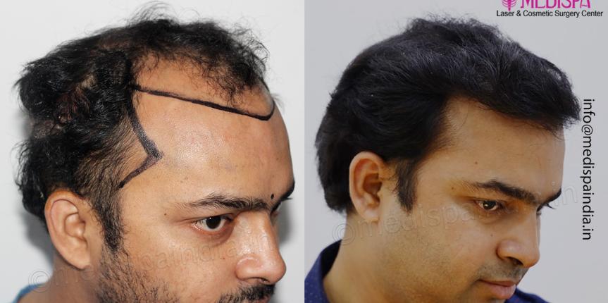top hair transplant clinic results delhi