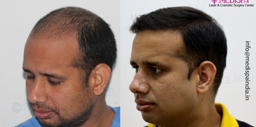 hair transplant india jaipur
