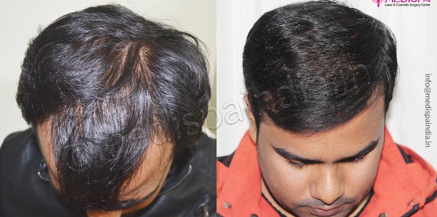 hair transplant clinics in chennai