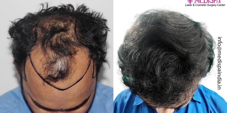top hair transplant clinic result bangalore