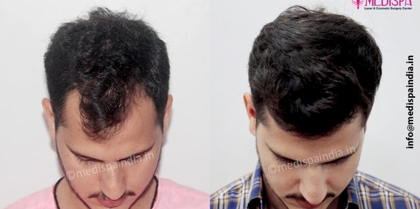 fue hair transplant doctor