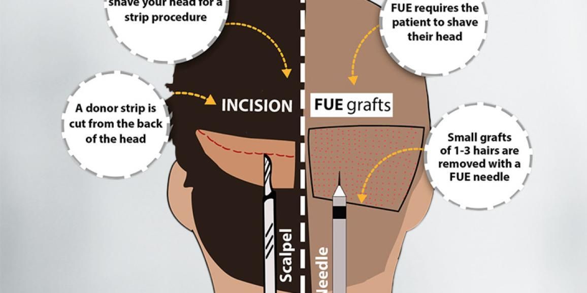 Hair Transplantation Techniques: FUE VS FUT