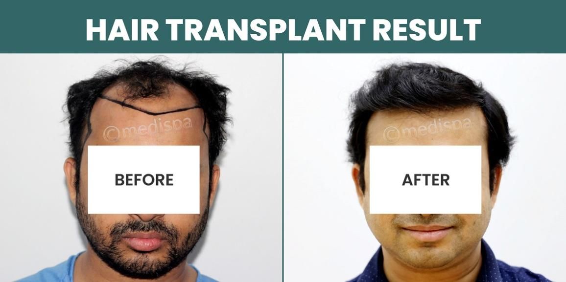 Hair Transplant Success: What Are The Chances Of Achieving Your Desired Results?