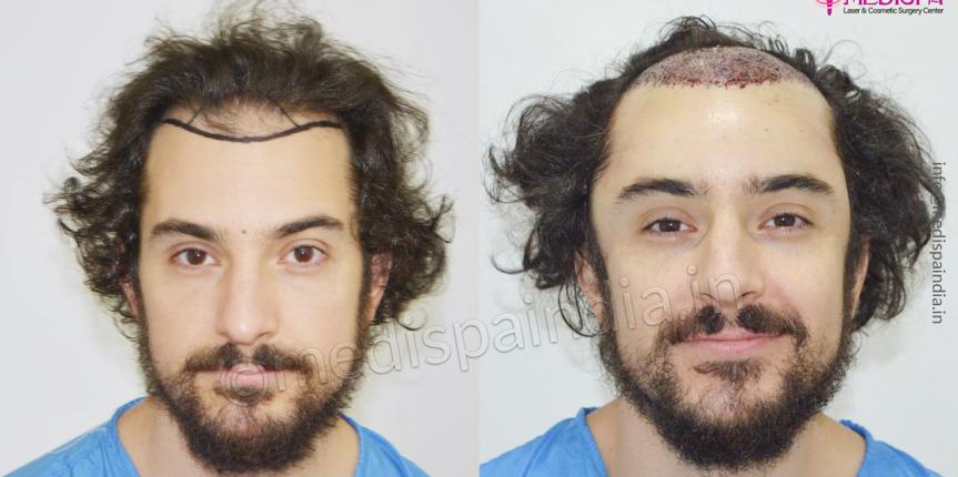 uas hair restoration results