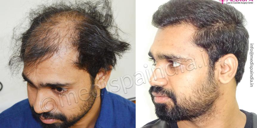 medispa hair transplant cost