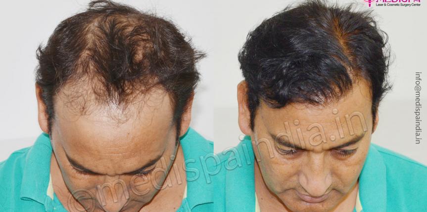 hair transplant in greater kailash