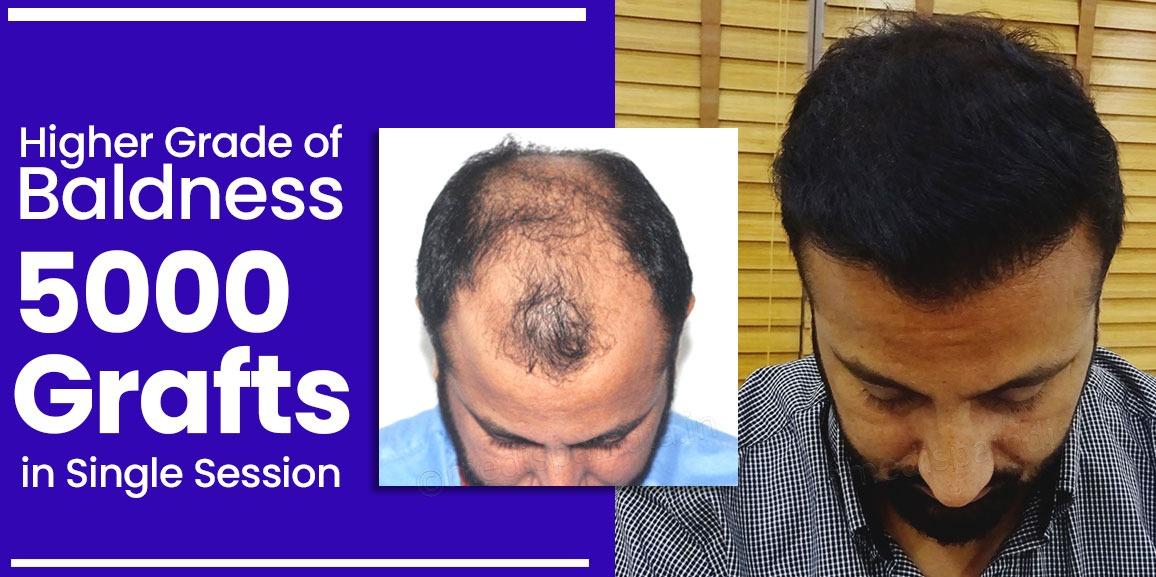 Why is FUT+FUE+BHT Hair Transplant Better Technique Than Other Methods?