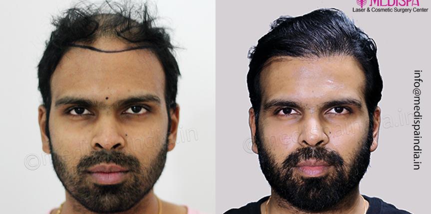 hair transplant results after 12 months