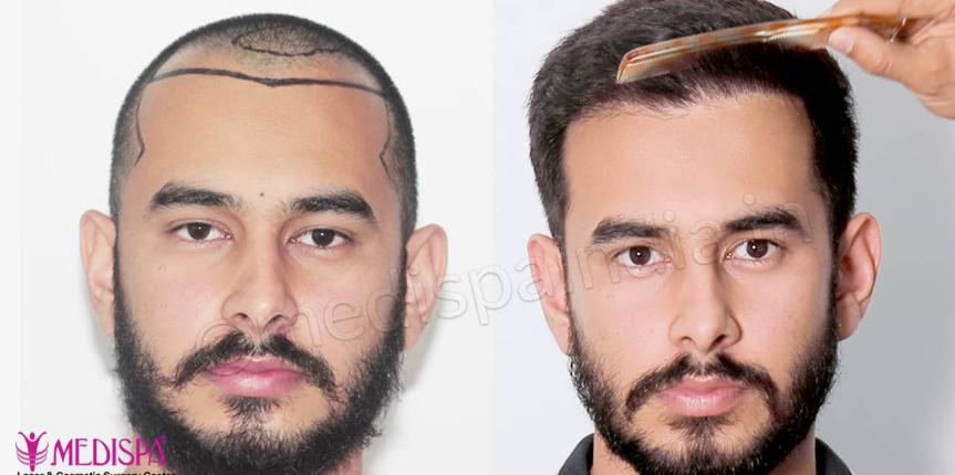 best hair transplant india