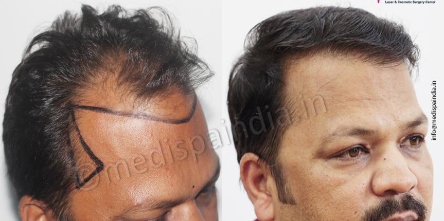 hair transplant price in jaipur