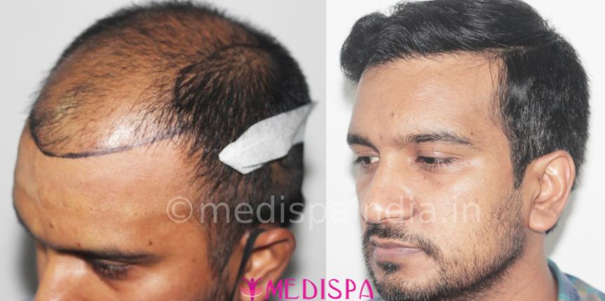 best hair transplant cost in jaipur