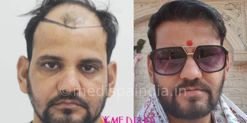 best hair transplant results in delhi