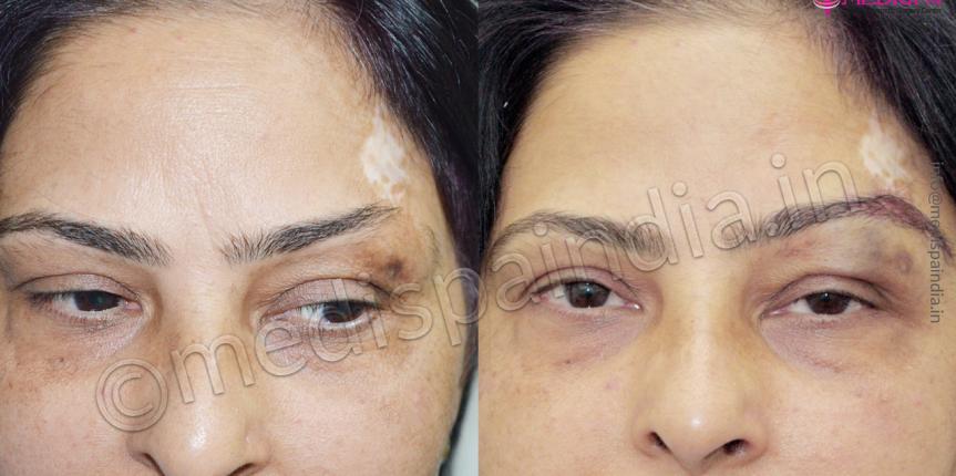 eyebrow hair transplant delhi