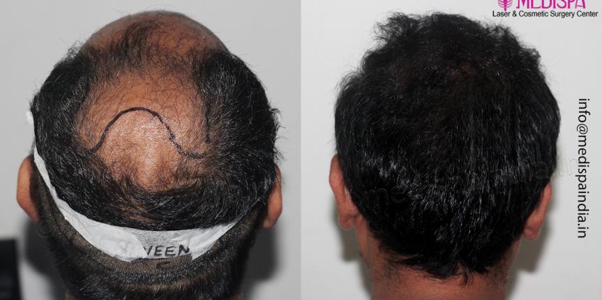 best hair transplant results bangalore