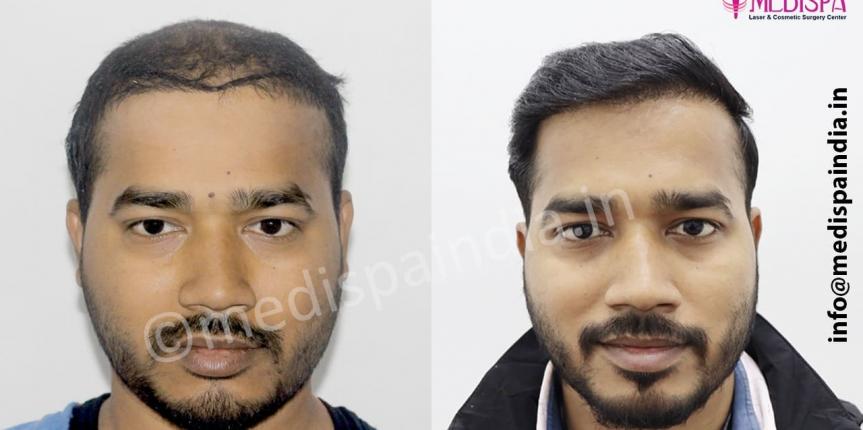 wrong hair transplant repair in delhi