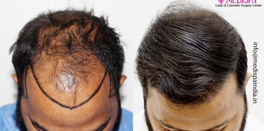 hair restoration results delhi