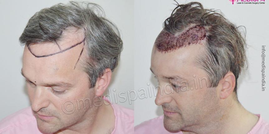 hair transplant before after uk