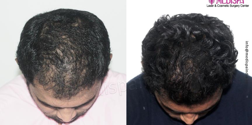 hair transplant before after in chennai