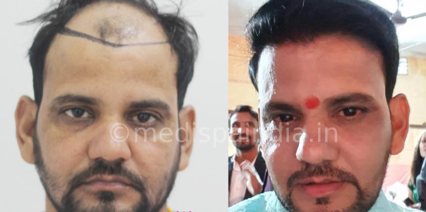 hair transplant before and after