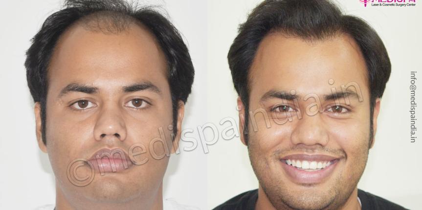 hair transplant in bikaner