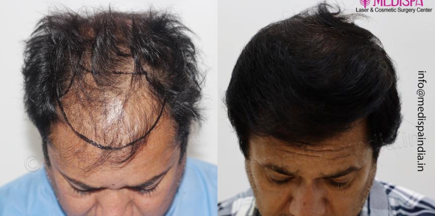 Best Hair Transplant in Delhi