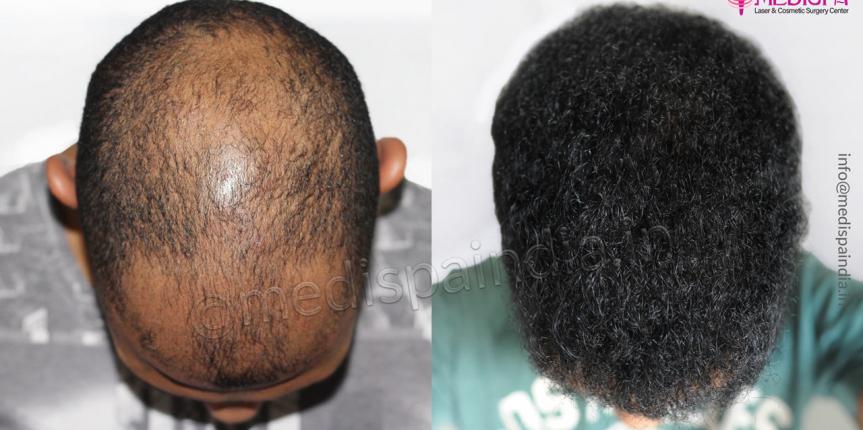 hair transplant in curly hairs