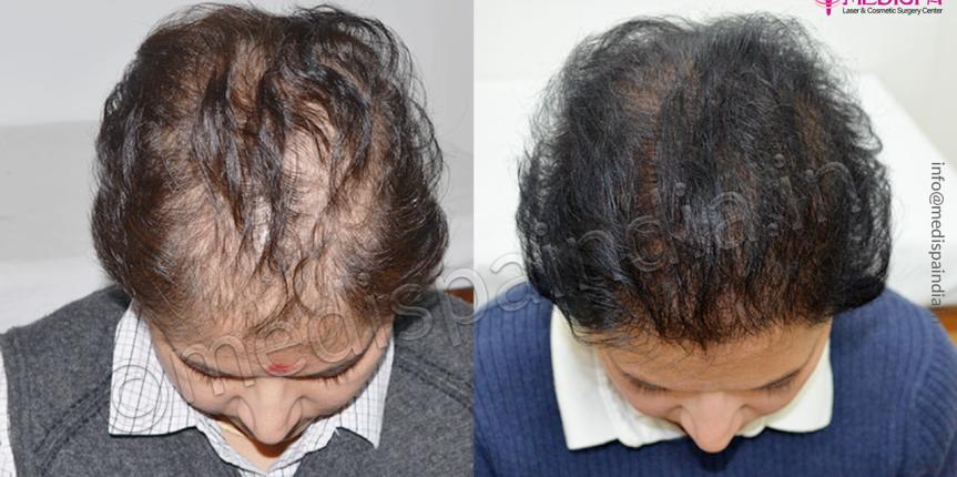 female hair transplant cost delhi