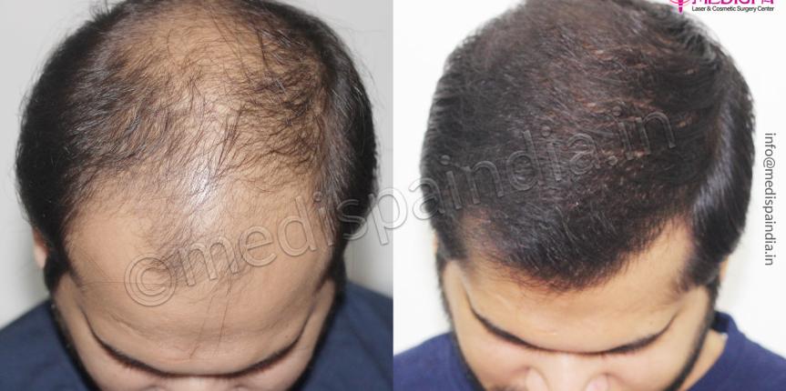 hair transplant surgeons in bikaner