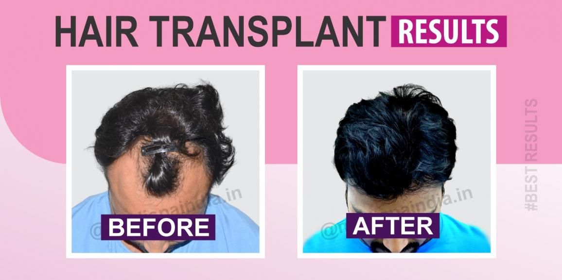 What is The Success Rate of FUT+FUE+BHT Hair Transplant Method?