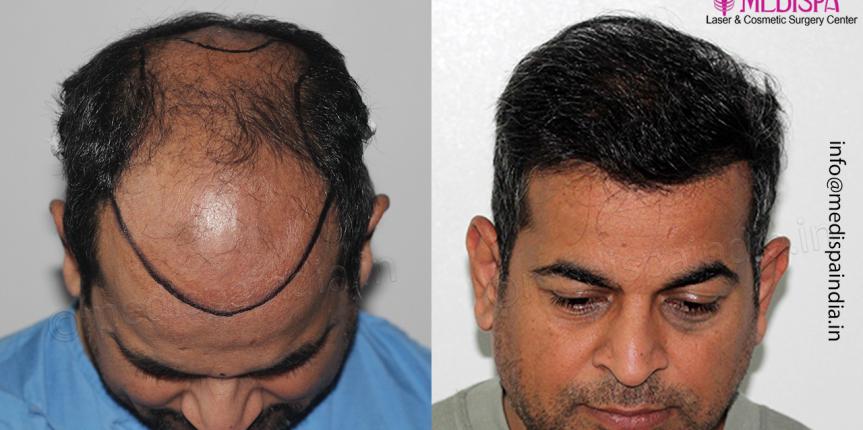 best hair transplant surgeon results bangalore