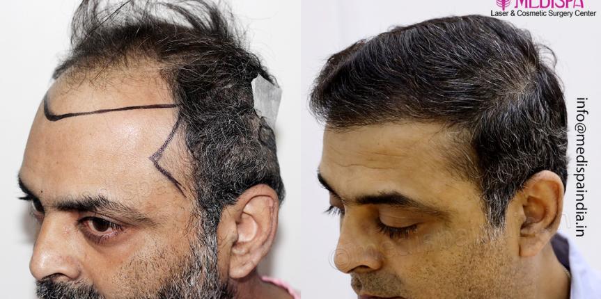 best hair transplant result canada