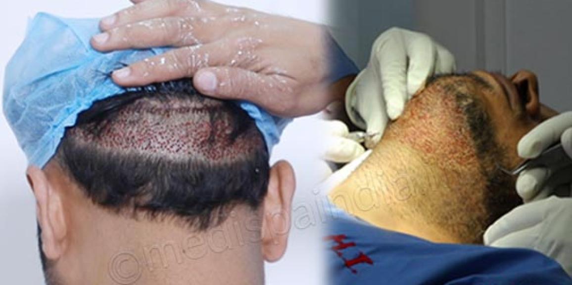 When to choose FUT or FUE Hair Transplant Technique