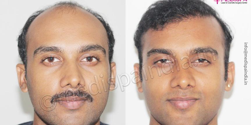 hair restoration cost india