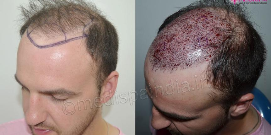 hair transplant in ireland