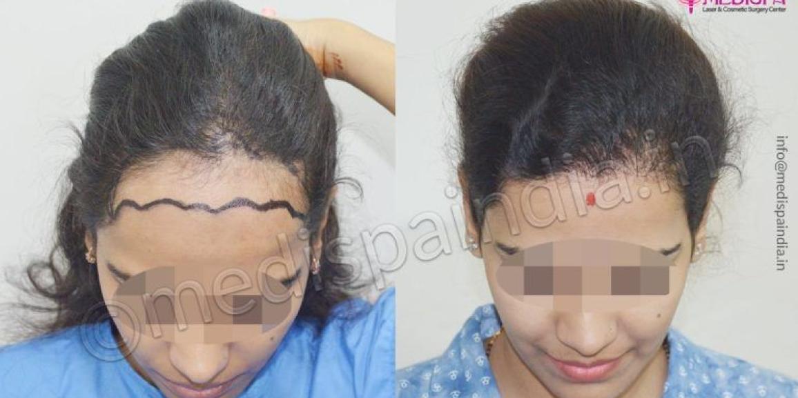 Is Hair Transplant For Women Effective?